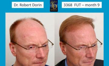 Hair restoration procedure before and after results