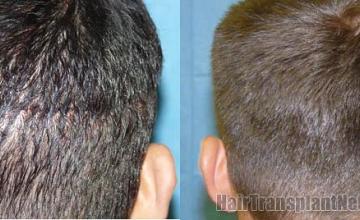 Residual scar after hair restoration procedure