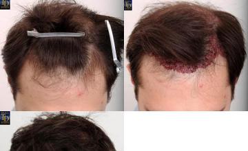 Hair restoration procedure before and after pictures