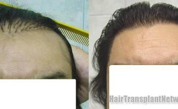 Hair transplant before and after repair photos