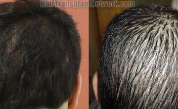 Hair transplantation surgery before and after pictures