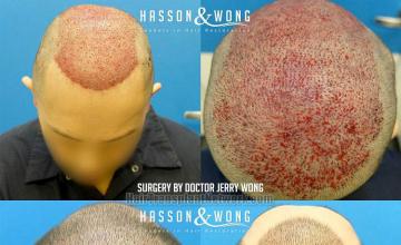 Hair restoration procedure before and after result images