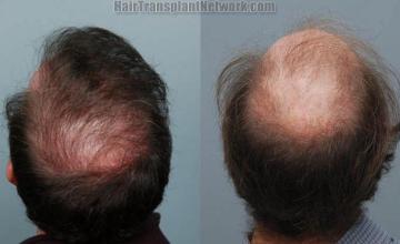 Hair restoration before and after images