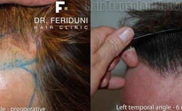 Hair transplant pictures showing left oblique angle results