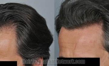 Hair transplantation surgery before and after images