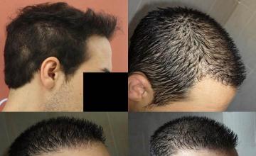 Hair transplantation surgery before and after photos