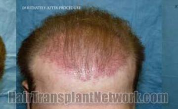 Top view before and after hair restoration results