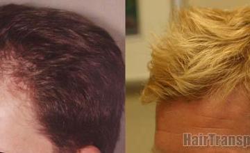 Hair restoration procedure results