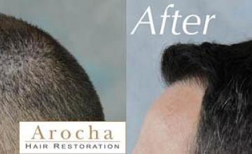 Hair transplantation surgery before and after pictures