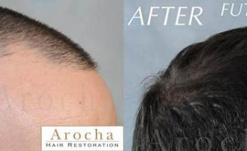 Hair transplantation surgery before and after images