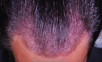 Hair transplantation surgery before and after pictures