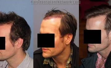 Left view before and after hair transplantation procedure 