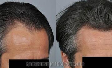 Hair transplantation surgery before and after photos