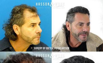 Hair transplantation procedure before and after results