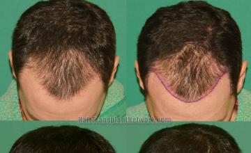 Before and after hair restoration procedure images