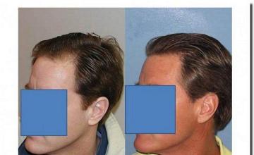 Hair restoration procedure results