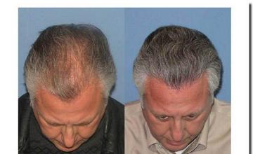 Hair restoration procedure results