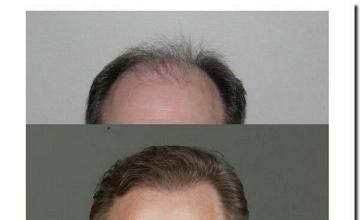 Hair restoration procedure results