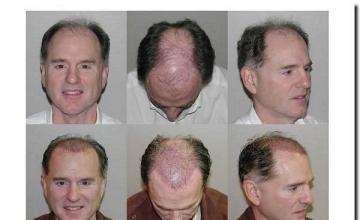 Hair restoration procedure results