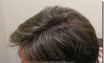 Hair restoration procedure results