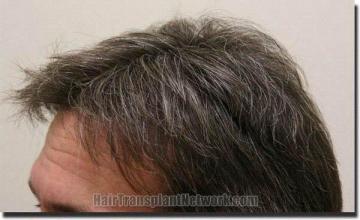 Hair restoration procedure results