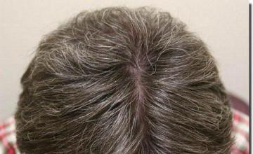 Hair restoration procedure results