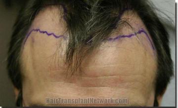 Hair restoration procedure results