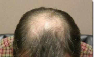 Hair restoration procedure results