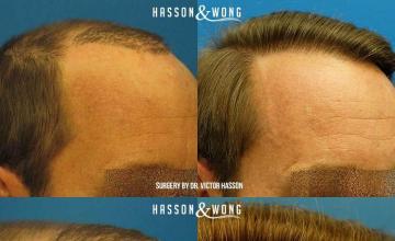 Hair transplantation surgery before and after images