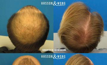 Hair restoration procedure before and after pictures