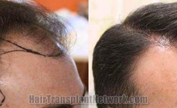 Hair transplantation surgery before and after photos