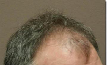 Hair restoration procedure results