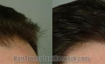 Hair transplantation surgery before and after photos