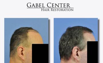 Hair transplantation surgery before and after photos