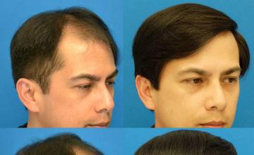 Hair replacement surgery before and after images