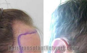 Hair transplantation surgery before and after pictures