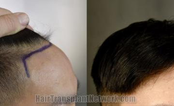 Hair transplantation surgery before and after images