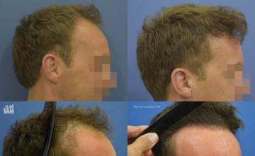 Hair transplantation surgery before and after images