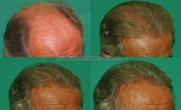 Hair restoration procedure before and after results