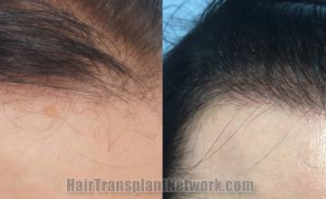 Hair transplantation surgery before and after images