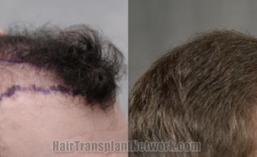 Hair transplantation surgery before and after images