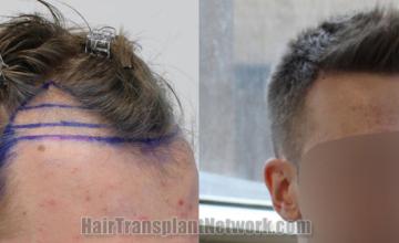 Hair transplantation surgery before and after images