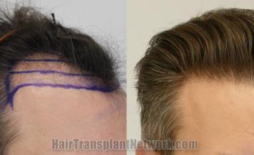 Hair transplantation surgery before and after images