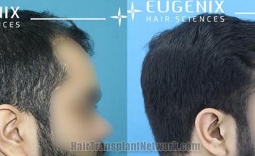 Hair transplantation surgery before and after images