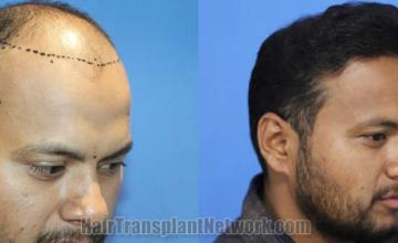 Hair restoration procedure before and after pictures