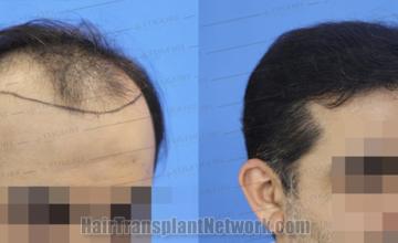 Hair transplantation surgery before and after images