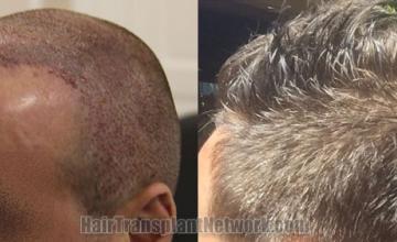 Hair transplantation surgery before and after images