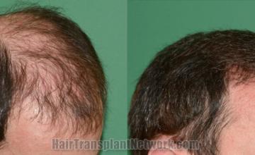 Hair transplantation surgery before and after images