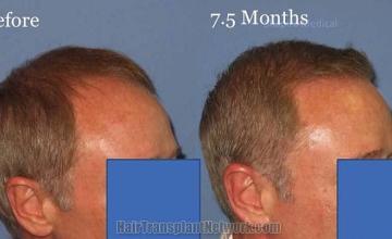 Hair transplantation surgery before and after photos