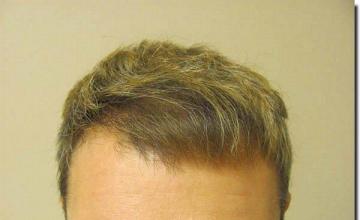 Hair restoration procedure results